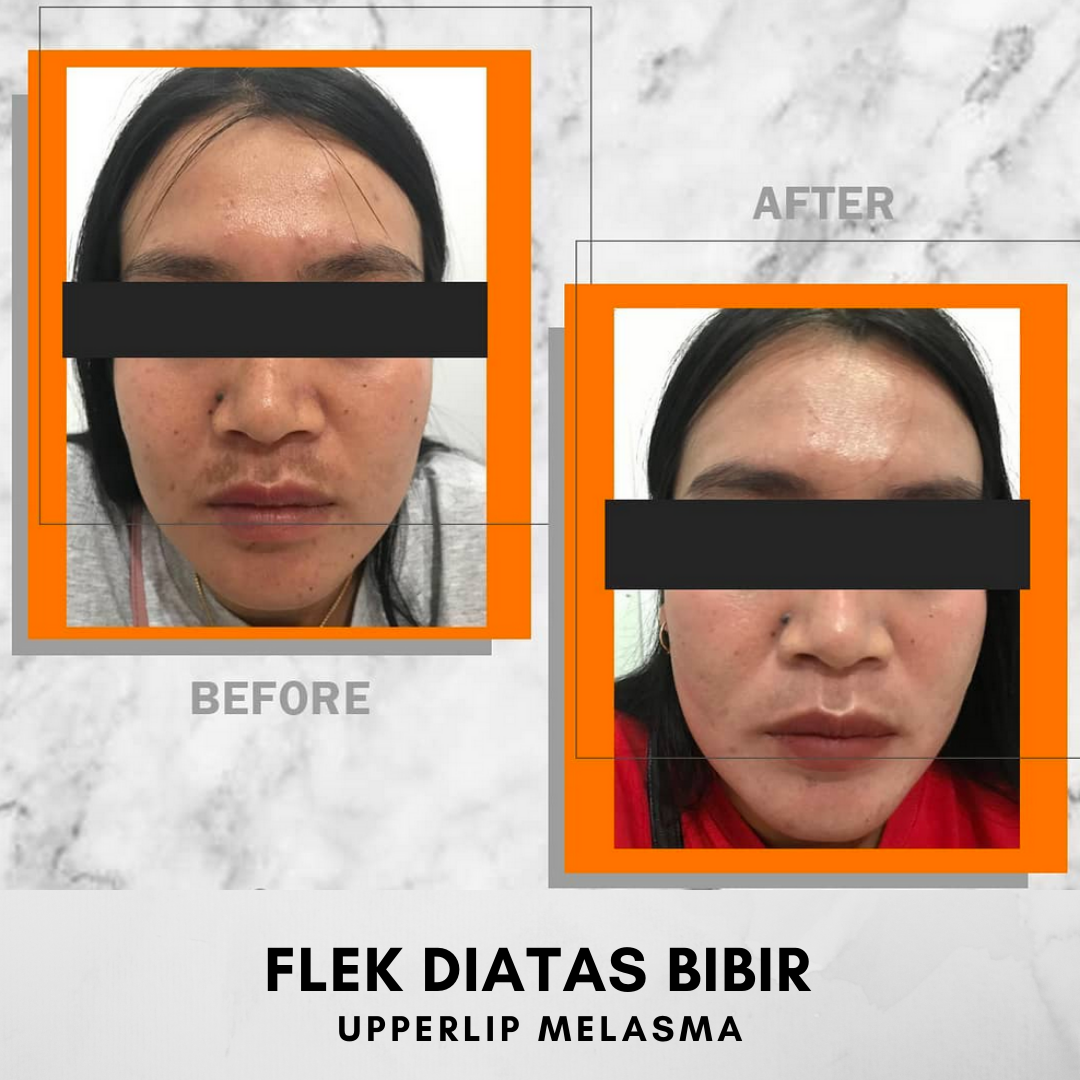 HASIL BEFORE AFTER KLINIK MAGNA BELITUNG JERAWAT, FLEK, MELASMA, KULIT BERMINYAK, KULIT KERING