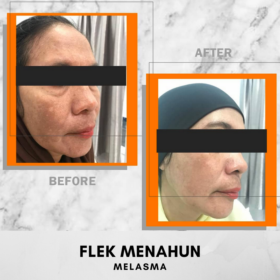 HASIL BEFORE AFTER KLINIK MAGNA BELITUNG JERAWAT, FLEK, MELASMA, KULIT BERMINYAK, KULIT KERING