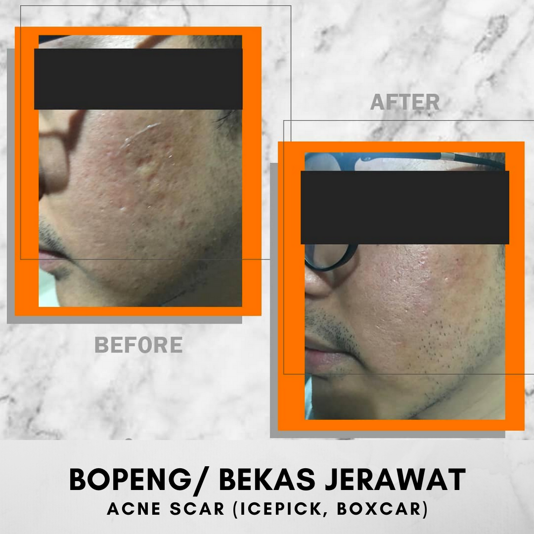 HASIL BEFORE AFTER KLINIK MAGNA BELITUNG JERAWAT, FLEK, MELASMA, KULIT BERMINYAK, KULIT KERING, KULIT KOMBINASI, BEKAS JERAWAT, BOPENG