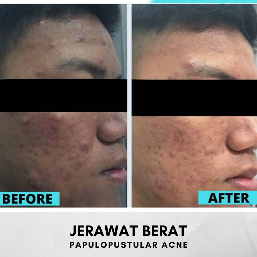 HASIL BEFORE AFTER KLINIK MAGNA BELITUNG JERAWAT FLEK MELASMA KULIT BERMINYAK KULIT KERING KULIT KOMBINASI BEKAS JERAWAT BOPENG