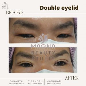 Read more about the article Cara Membuat Double Eyelid Permanen