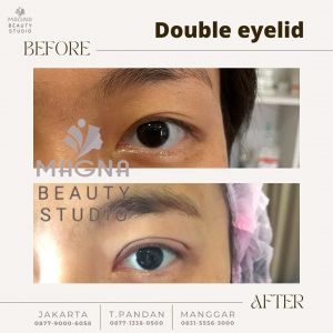 eyelid stitching jakarta