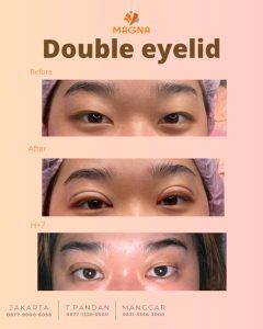 perbedaan monolid dan double eyelid