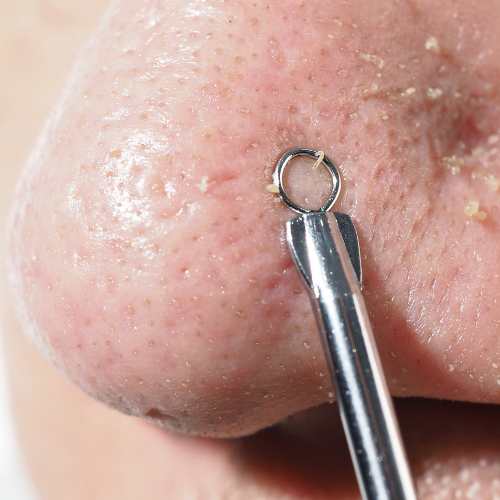 Read more about the article Cara Menghilangkan Komedo di Hidung: 9 Tips