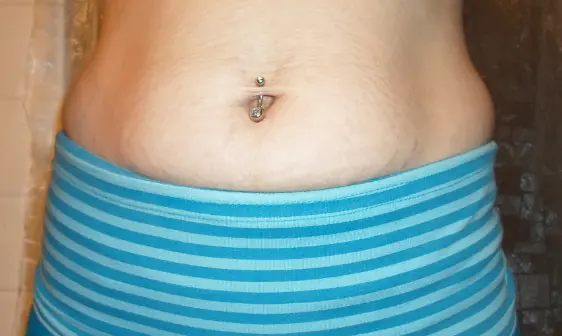 penghilang stretch mark
