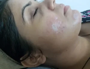 Read more about the article Chemical Peeling Adalah: Manfaat dan Cara Kerjanya