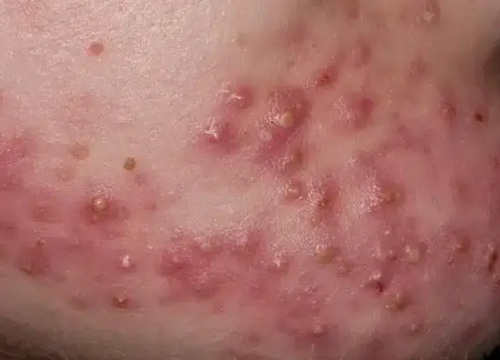 jerawat pustula