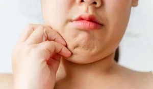 Read more about the article Mesolipo Double Chin: Solusi Efektif dan Aman