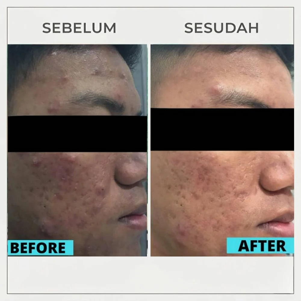 Before After Scar Bopeng 3