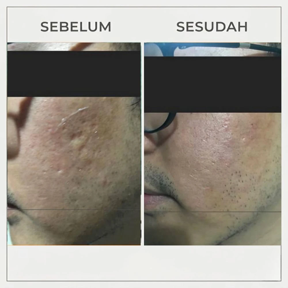Before After Scar Bopeng 2