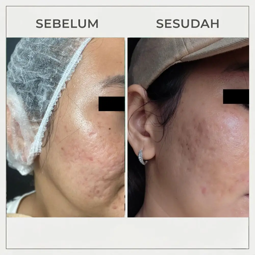 Before After Scar Bopeng 1