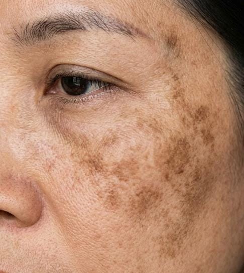 Perawatan Melasma