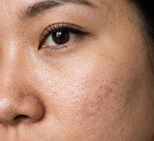 Read more about the article Scar Treatment: Jenis, Cara Kerja & Estimasi Harga [2026]