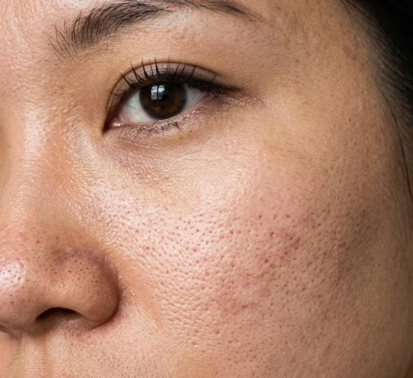 Acne Scar Treatment