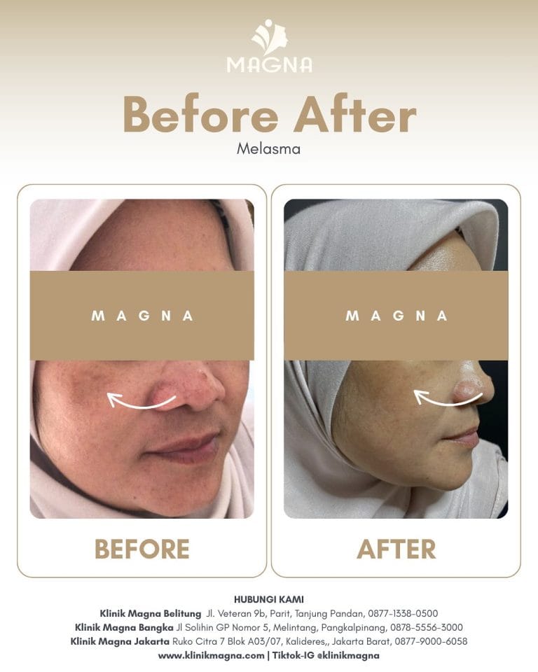 ✨ Melasma Bukan Lagi Masalah ✨Kulit jadi lebih cerah, noda memudar, jadi ga usah minder lagi yaa