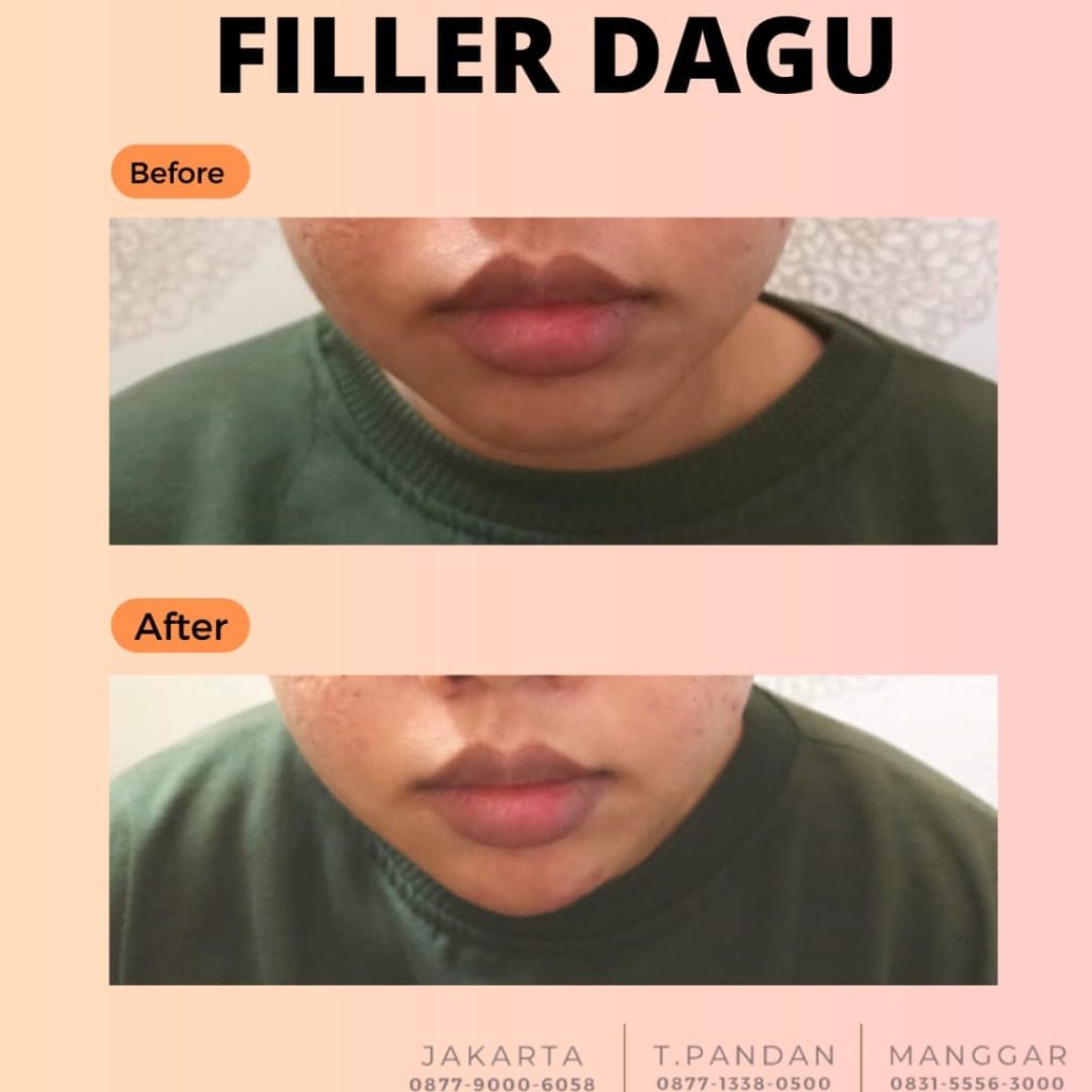 Filler Dagu Klinik Magna Belitung