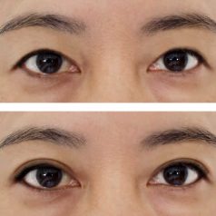 eyelid jakarta magna